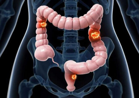 چهار علامت نشان دهنده ابتلای افراد جوان به سرطان روده