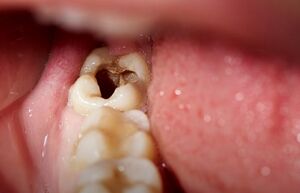 عواقب وجود دندان پوسیده در دهان