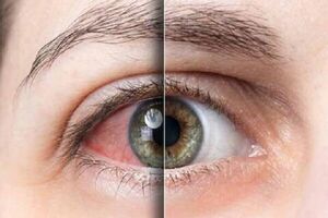 خشکی چشم چه علایمی دارد؟